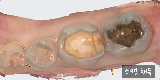 인레이 제거 후 스캔 채득